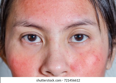 Face Of A Young Woman With Red Rash. Skin Irritation. Acne Treatment Concept, Closeup.