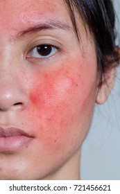 Das Gesicht einer jungen Frau mit rotem Ausschlag. Hautreizung. Akne Behandlungskonzept, Nahaufnahme.