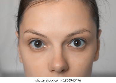 Face of young woman without makeup with closeup eyes, nose and forehead. Caucasian female with brown eyes and freckles on face skin looking at camera. She has the expression of a tired person.
