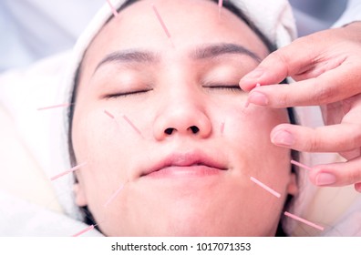 facial acupuncture on woman face
