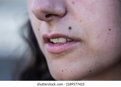 Facial Hair Of Girl. Small Mustache Near The Mouth Of A Woman With Many Moles. Aestheticism And Skin Defects. Aesthetic Clinic And Hair Removal.
