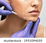 Facial lifting thread. Thread facelift with arrows on face for woman