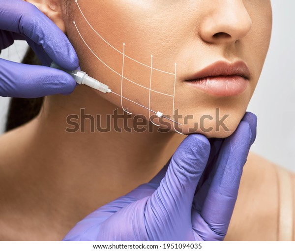 Facial lifting thread. Thread facelift with\
arrows on face for woman\'s skin, procedure facial contouring using\
mesothreads