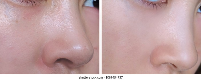 Facial Skin Before And After Using Makeup Base Compared To Show The Smoother And Brighter Skin.