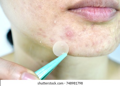 Facial skin problem, Close up woman face with whitehead pimples and acne patch, Scar and oily greasy face, Beauty concept.