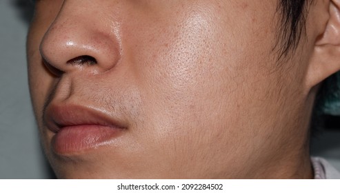 Fair Skin With Wide Pores In Oily Face Of Southeast Asian, Myanmar Or Korean Adult Young Man.