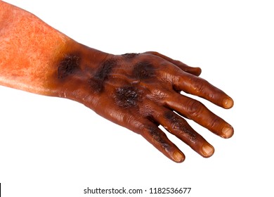 False Burned Hand, Paramedic Training Prop