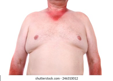 Farmer Tan, Sunburn Lines On An Obese Man