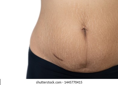 Fat Belly Scratch Mark Pregnancy Female Skin Surgical Operation Remove Appendix Scar