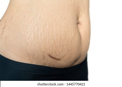 Fat Belly Scratch Mark Pregnancy Female Skin Surgical Operation Remove Appendix Scar