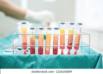 Fat With Blood In Syringes On Stainless Rack Waiting For Extract For Fat Grafting