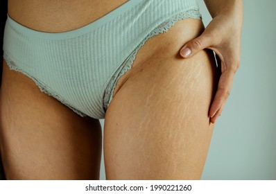 Fat Cellulite And Stretch Mark On Tan Skin Woman Leg At Home, Women Diet Styl - Shutterstock ID 1990221260
