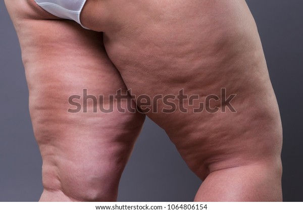 cellulite gambe