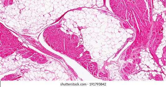 Fat Infiltration Of The Heart. Fatty Infiltration Of The Myocardium - Fat Cells Infiltrating The Cardiac Tissue Replacing Myocytes With Fibrosis. Fibrofatty Myocardium