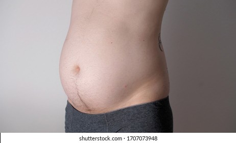 Fat Male Stomach. Weight Loss Or Weight Gain During Quarantine. Attractive Man With Bare Belly. Close-up Of Male Beer Belly Of Sexy Man. Bodypositive