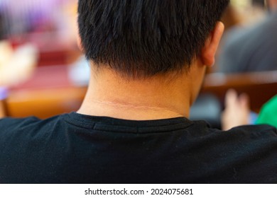 Fat man with black marks of the skin around the neck of an overweight man.One of the warning signs of diabetes. the medical health of acanthosis nigricans in a male with diabetes with a dark mark. - Shutterstock ID 2024075681