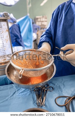 Fat separation procedure for buttock augmentation surgery. Separation of fat removed from the abdominal area using liposuction. A real operating room environment.