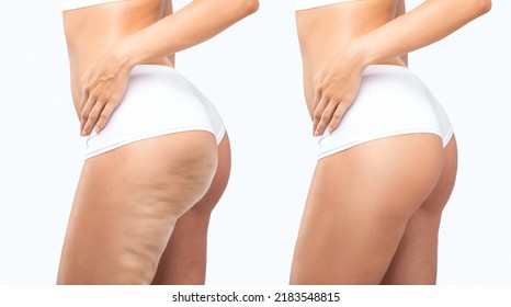 Fat woman with cellulite on her legs. Obese woman in white underwear.Overweight treatment.Photos in comparison before and after the treatment of overweight and cellulite. - Shutterstock ID 2183548815