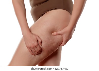 Fat Woman Pinching Her Leg And Showing Cellulite