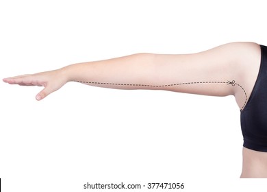 fat woman surgery mark arm cut body fat liposuction concept