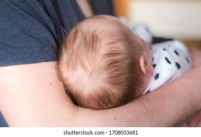 A Father Holiding A Newborn , Close Up On A Head (scalp) With Cradle Cap (infantile Seborrheic Dermatitis)