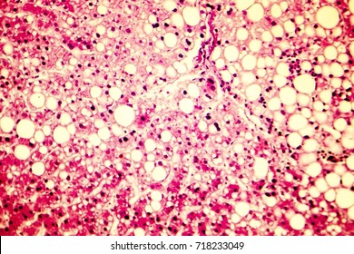 Fatty Liver, Liver Steatosis. Photomicrograph Showing Large Vacuoles Of Triglyceride Fat Accumulated Inside Liver Cells, It Occurs In Alcohol Overuse, Under Action Of Toxins, In Diabetes