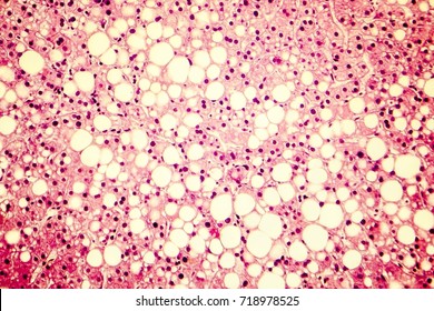 Fatty Liver, Liver Steatosis. Photomicrograph Showing Large Vacuoles Of Triglyceride Fat Accumulated Inside Liver Cells, It Occurs In Alcohol Overuse, Under Action Of Toxins, In Diabetes