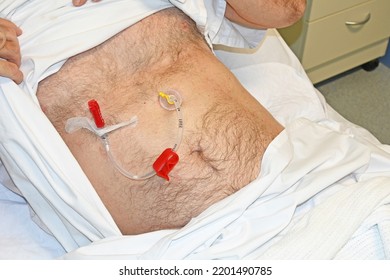 Feeding tube inserted into a mans stomach - Shutterstock ID 2201490785