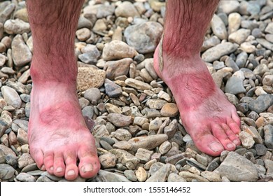 Feet Burnt Sun While Relaxing On Stock Photo 1555146452 | Shutterstock