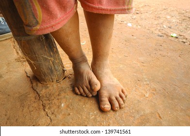 The Feet Of A Child Living In Poverty In Laos