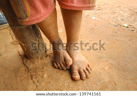 The Feet of a Child Living in Poverty in Laos