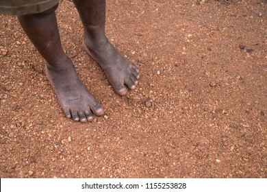 The Feet Of Child Living In Poverty In Uganda, Africa