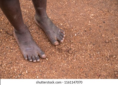 The Feet Of Child Living In Poverty In Uganda, Africa