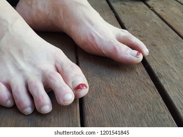 Feet With Chipped Nail Polish. 