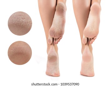 Feet With Dry Skin Before And After Treatment.