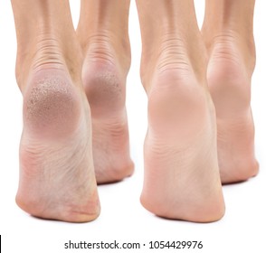 Feet With Dry Skin Before And After Treatment.