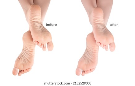 Feet with dry skin before and after treatment. foot cream, moisturizer. Dry and cracked soles of feet. female legs in an elegant position. sore skin of feet, dry heels - Shutterstock ID 2152529303