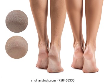 Feet With Dry Skin Before And After Treatment.