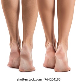 Feet With Dry Skin Before And After Treatment.