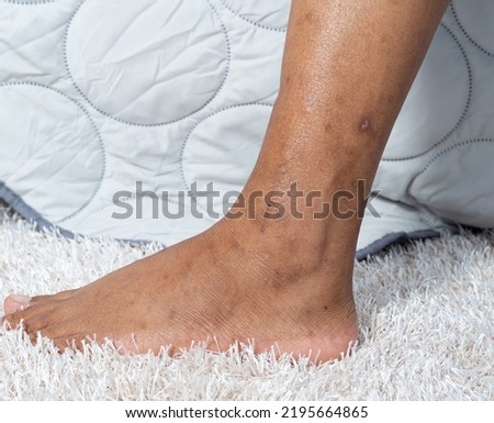 Feet and legs Skin on the feet and legs with scars and dark spots Makes the skin unattractive, uneven skin tone It is a problem that can be found with all skin tones.