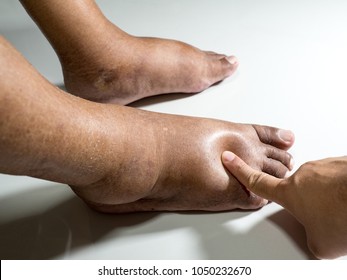 The feet of people with diabetes, dull and swollen. Due to the toxicity of diabetes placed on a white background. Fingers hit the back of the diabetic foot. To test foot swelling.