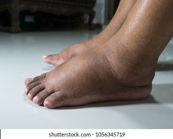 feet-people-diabetes-dull-swollen-260nw-1056345719.jpg