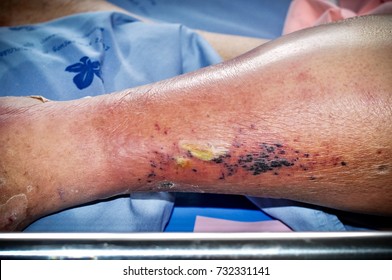 The feet of people with diabetes, dull and swollen. Due to the toxicity of diabetes, ulceration 