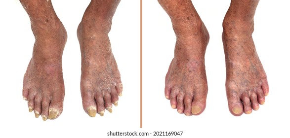 Feet Of A Very Old Man With Long And Damaged Nails And Dry Skin Before And After Pedicure Treatment. Isolated On The White Background. 