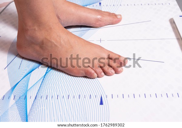 Feet of a woman on the table for\
the biomechanical study of the tread and position of the\
foot