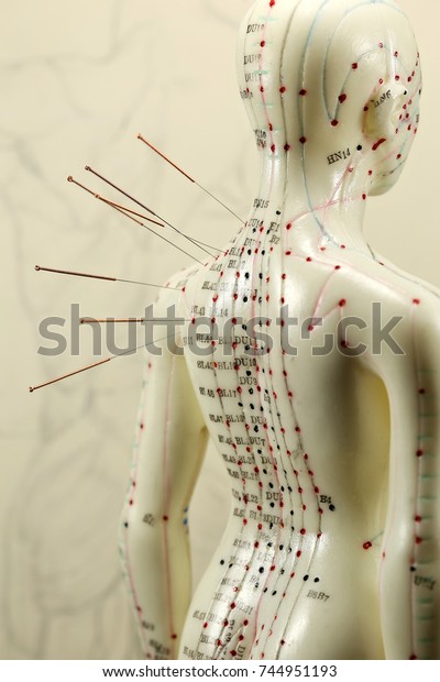 Female Acupuncture Model Needles Shoulder Stock Photo 744951193 ...