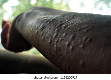 Female Arm With Poison Ivy Rash