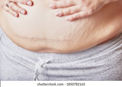 Female Belly After Childbirth, Excess Fat And Stretched Skin