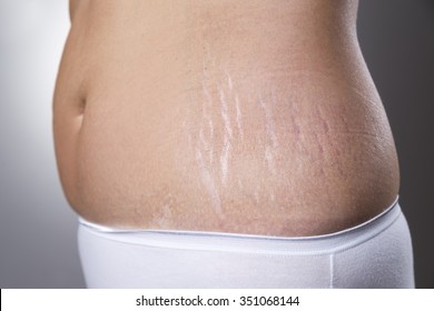 Female belly with pregnancy stretch marks closeup on a gray background