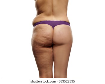 female body before and after liposuction